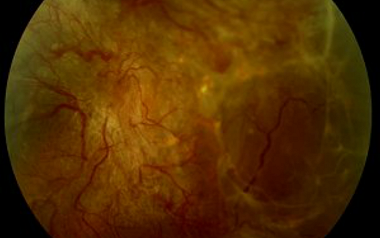 Retinal Surgery